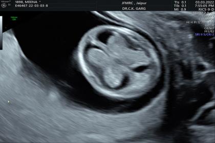 Early Pregnancy scan 