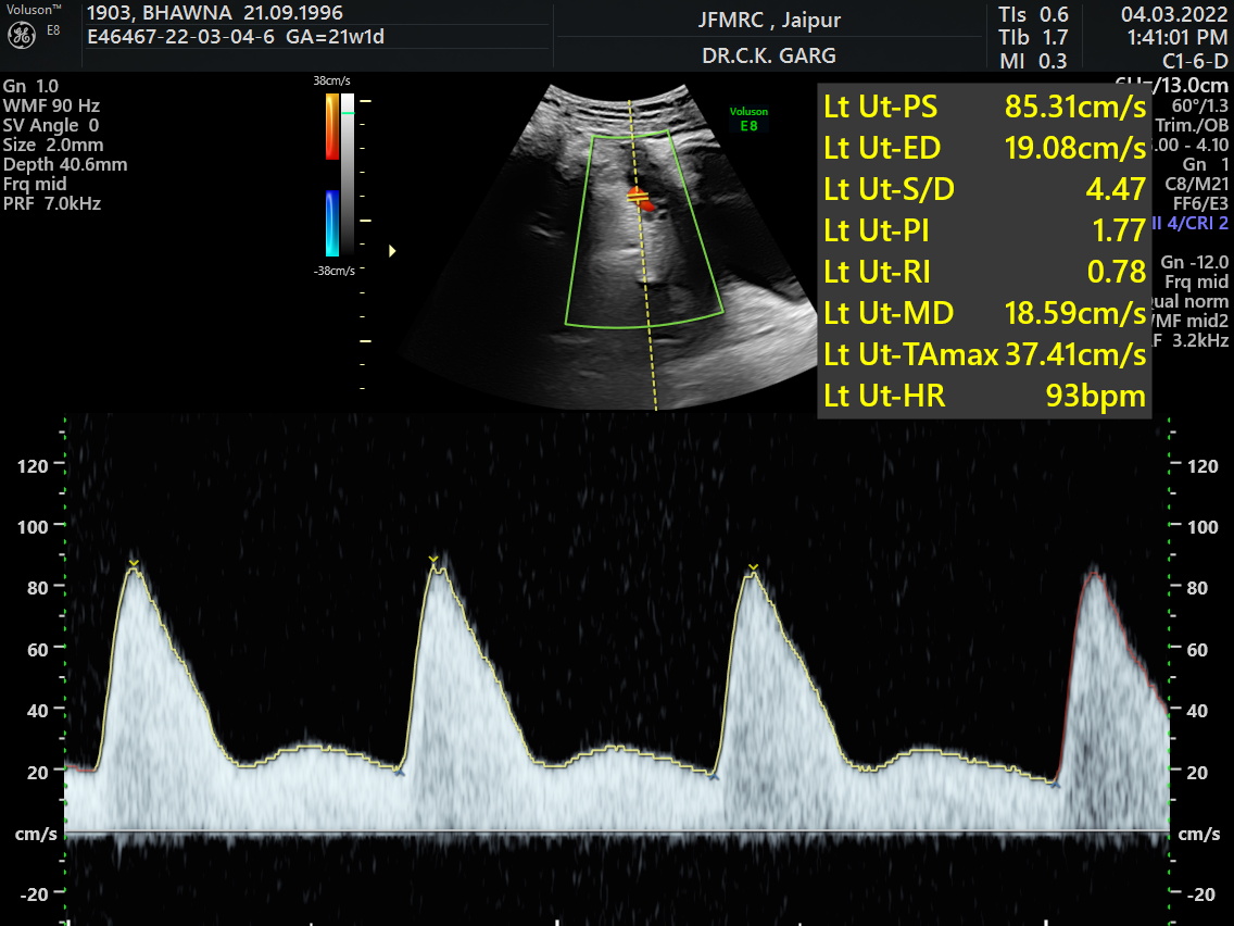 Fetal Doppler study